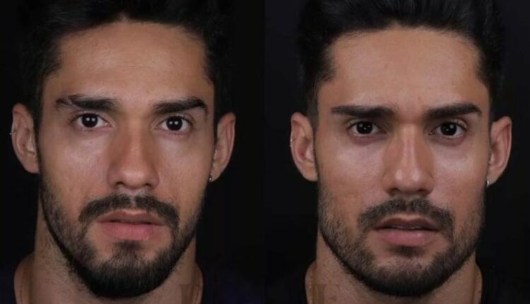 Antes e depois de arcrebiano na harmonização facial