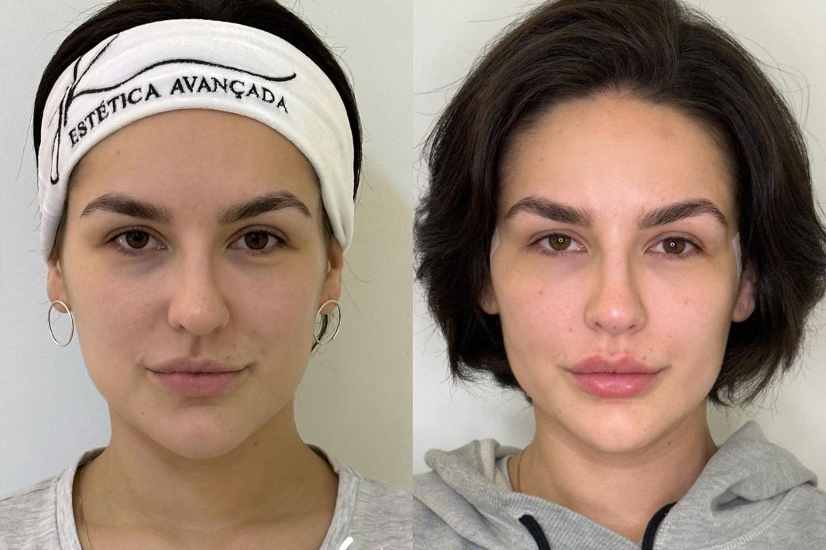 Antes e depois harmozinacao facial